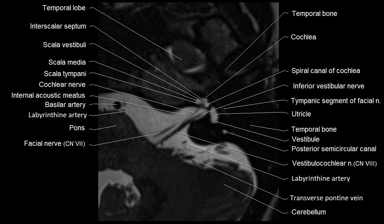 Internal auditory canal (IAC) axial cross sectional anatomy image 12.webp